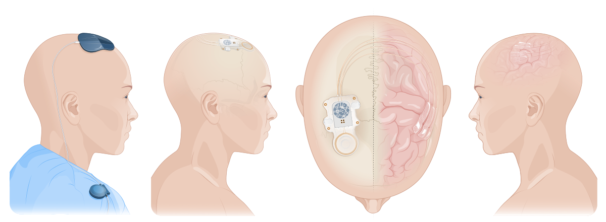 ABILITY system overview